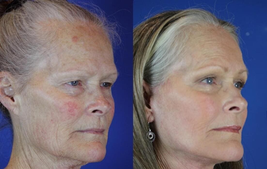 Fine Lines & Wrinkles